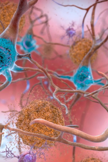 Start of new era for Alzheimer’s treatment
